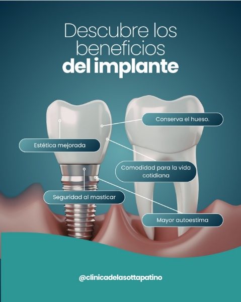 Pieza de nuestro Instagram: Descubre los beneficios del implante